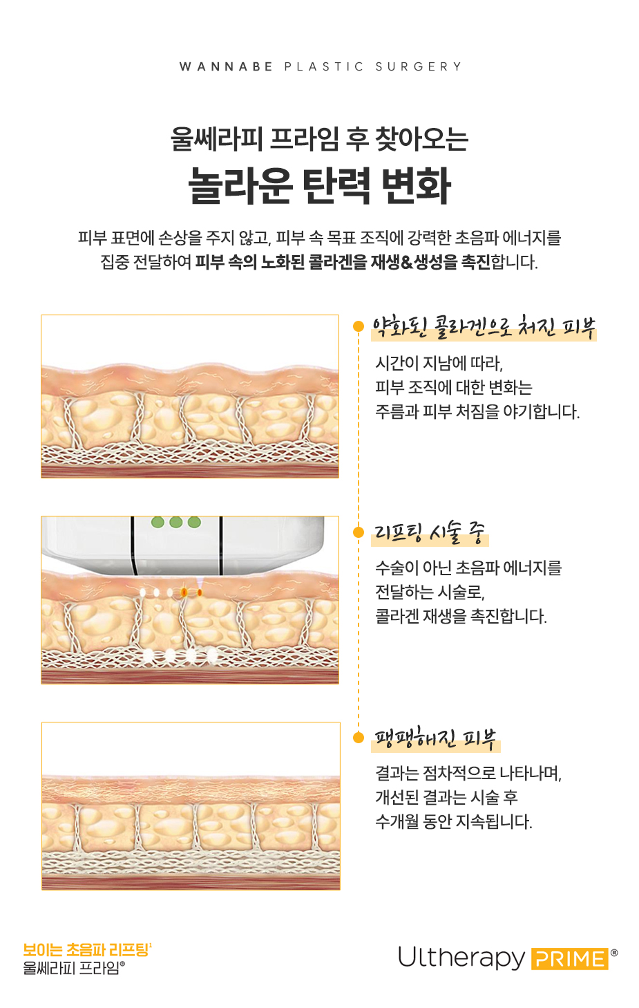 울쎄라피 프라임 후, 찾아오는 놀라운 변화 - 피부 표면에 손상을 주지 않고, 피부 속 목표 조직에 강력한 초음파 에너지를 집중 전달하여 피부 속의 노화된 콜라겐을 재생&생성을 촉진합니다.