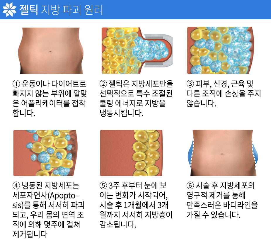 젤틱-지방파괴원리