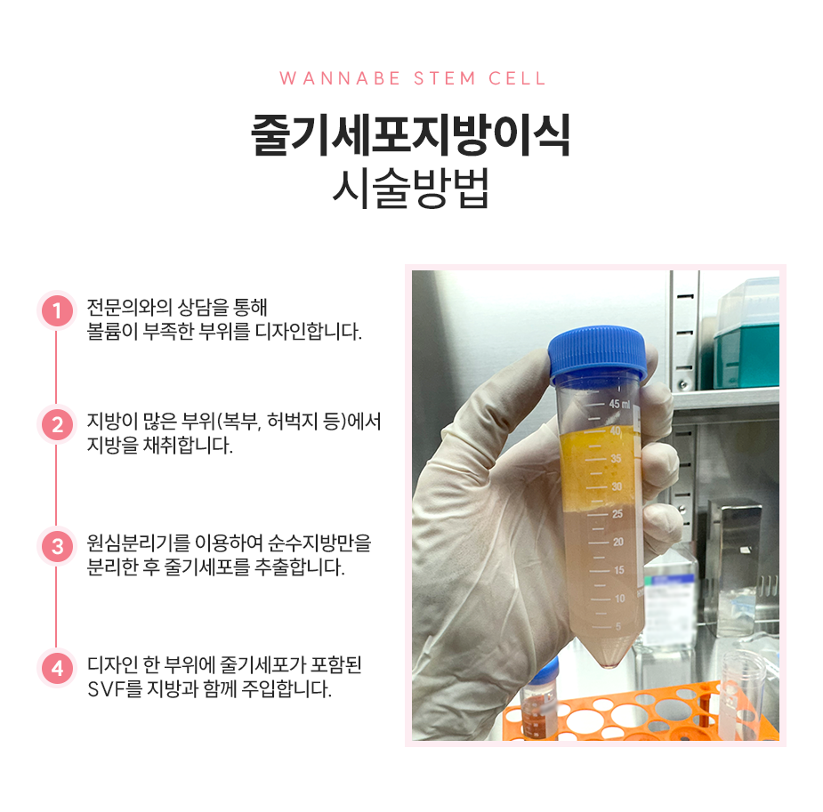 줄기세포 지방이식 시술방법 - 1.전문의와의 상담을 통해 볼륨이 부족한 부위를 디자인합니다. 2.지방이 많은 부위(복부,허벅지 등)에서 지방을 채취합니다. 3. 원심분리기를 이용하여 순수지방만을 분리한 후 줄기세포를 추출합니다. 4. 디자인 한 부위에 줄기세포가 포함된 SVF를 지방과 함께 주입 합니다.